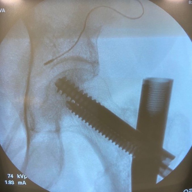 Femoral PNS for Dynamic Hip Screw